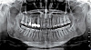 Дентальный томограф NewTom 2D/3D GO (10x10) - Фото 9